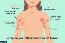 CA BREAST & RECON