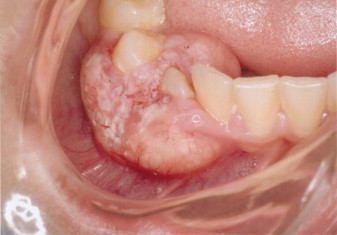 SCC MANDIBLE